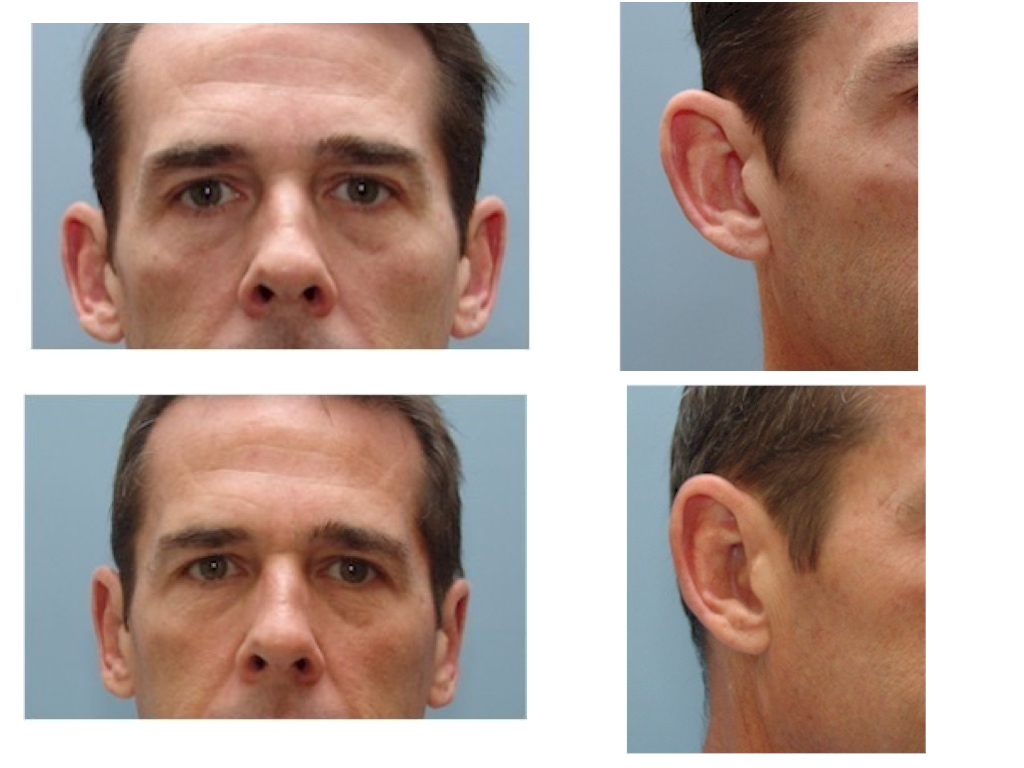 OTOPLASTY
